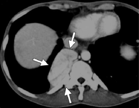 Hyaline Vascular Castleman Disease Mimicking A Mass In The Posterior