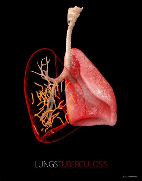 Bakterien Mykobakteriumtuberkulose Stock Abbildung Illustration Von