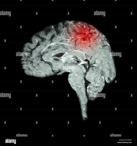 Magnetic Resonance Imaging Mri Of Brain And Stroke Medical