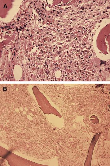 Atypical Presentation Of Therapy Related Acute Promyelocytic Leukaemia