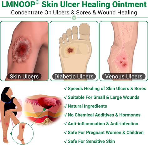 Buy LMNOOP® Skin Ulcer Healing Ointment, for Foot & Leg Ulcers, Sores ...