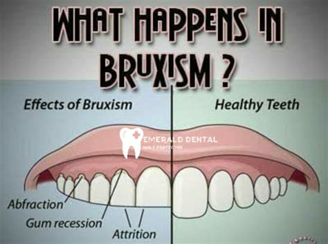 Bruxism Emerald Dental