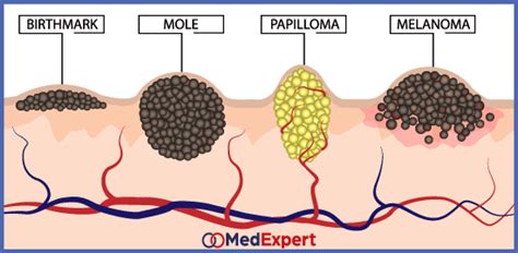 Cancerous moles treatment, diagnostics services and symptoms | MED Expert