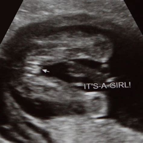 Its A Girl Ultrasound 16 Weeks