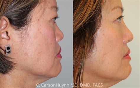 Asian Rhinoplasty Case 3185 Radiance Surgery Aesthetic Medicine