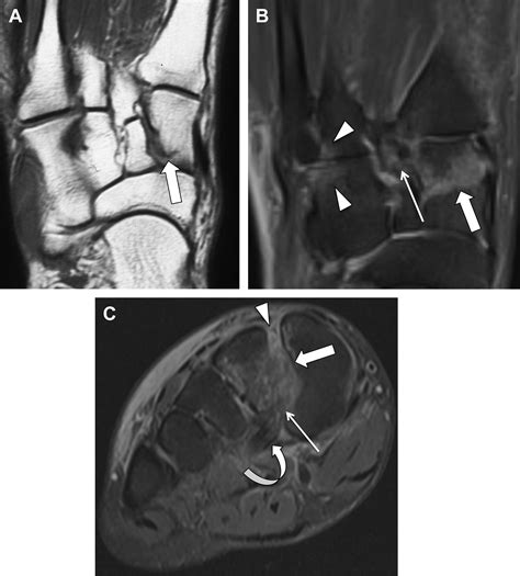 Mr Imaging Of The Midfoot Including Chopart And Lisfranc Joint