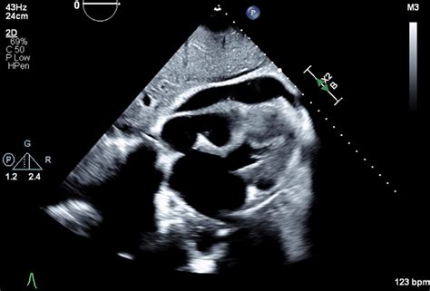 Transthoracic Echocardiogram | Download Scientific Diagram