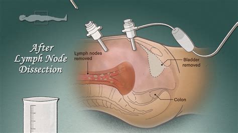 Predicting Local Recurrence Of Bladder Cancer After Radical Cystectomy