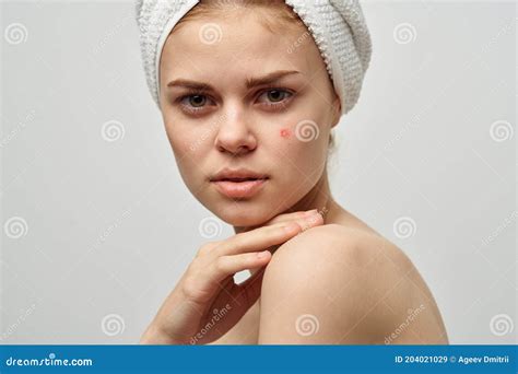 Attractive Woman With Towel On Head Naked Shoulders Pimples On Face Acne Skin Care Stock Image