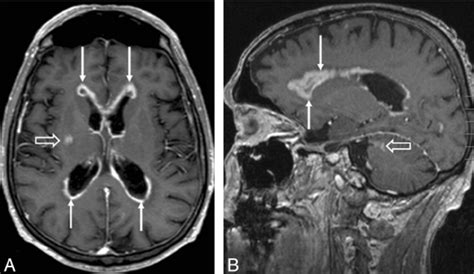 Axial A And Sagittal B T1 Weighed Contrast Enhanced Mr Images