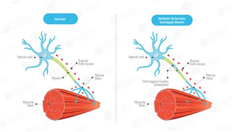 Multiple Sclerosis (MS) – Find the Best Stem Cell Treatment | GSC