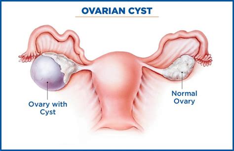 Laparoscopic Ovarian Cystectomy Ovarian Drilling