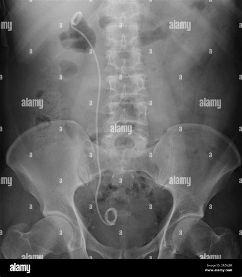 Urinary System Stent X Ray Stock Photo Alamy