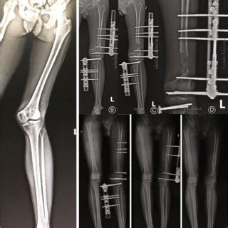 Perioperative And Follow Up Radiographs Of A Typical Lld Patient In Our