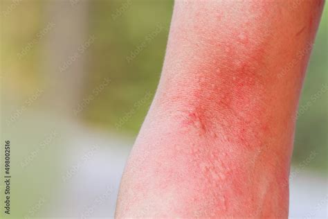 Close Up Skin Allergy Itching On Arm Skin Body Allergic A Caterpillar Sting Or Insect Bites