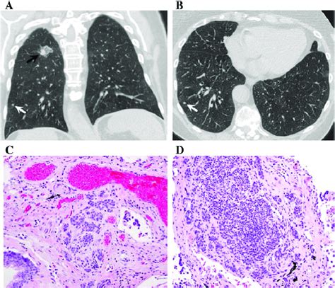 A 79 Year Old Female With Dipnech Pulmonary Adenocarcinoma And Download Scientific Diagram