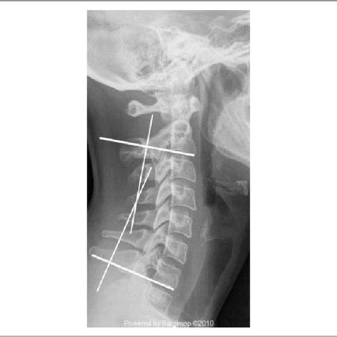 A Clinical Photograph Showing The Chin Brow Vertical Angle Cbva