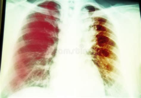 Radiographie Pulmonaire De L Infection Pulmonaire Photo Stock Image