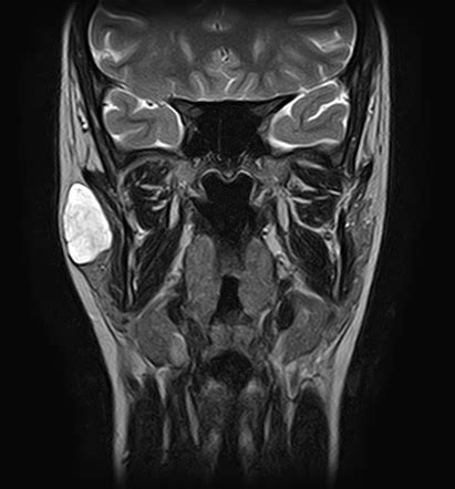 Pleomorphic Adenoma Parotid Gland Radiology Case Radiopaedia Org