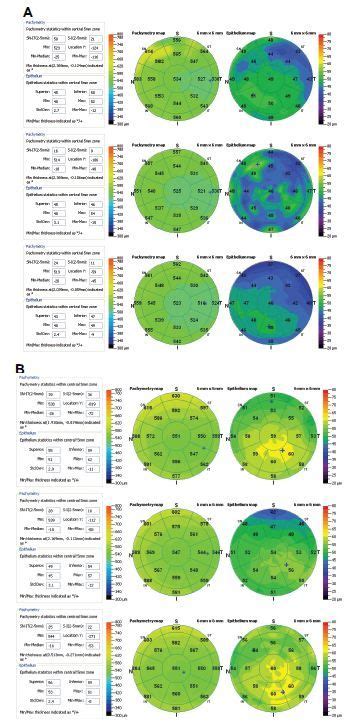 Corneal Pachymetry Conversion Chart