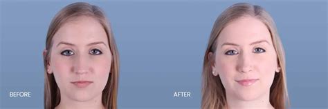 Before and After: Rhinoplasty Patient #42 - North Texas Plastic Surgery