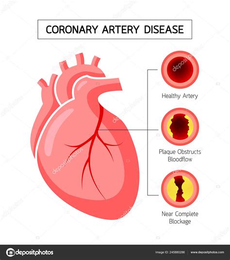 Wheels Bikes Los Angeles bike: [Download 45+] Coronary Heart Disease ...