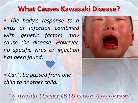 Ppt What Is Kawasaki Disease Powerpoint Presentation Free Download