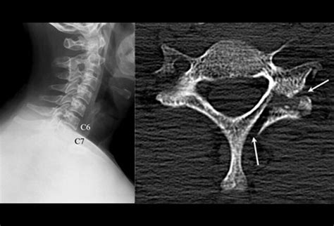 Interpretations of the C-Spine on Plain Radiography