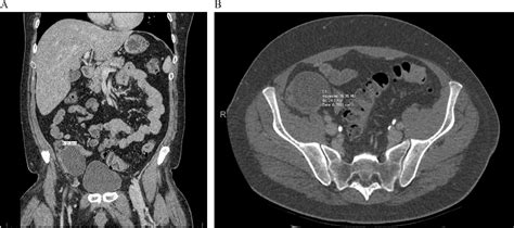 Figure From Caecal Dermoid Cyst Presenting As An Appendicular