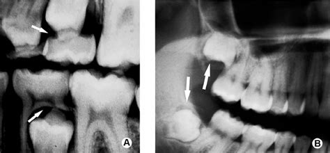 Preoperative Radiographs Showing That All Teeth Were Free Of Cracks