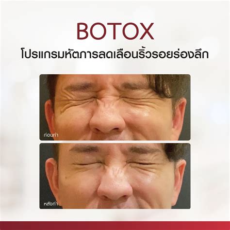 Review Botulinum Toxin - thescarlettclinic