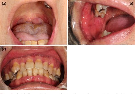 Necrotizing Ulcerative Gingivitis Before And After