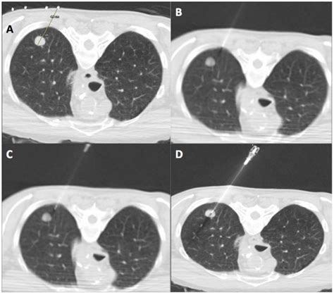 Ct Guided Percutaneous Core Biopsy Of Lung Pcbl A Lesion Is