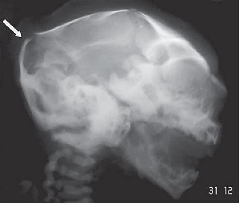 Figure From Giant Occipital Encephalocele Associated With