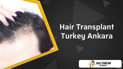 The Hair Implants Asli Tarcan Clinic Best Hair Transplant