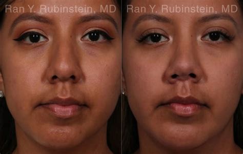 Ethnic Rhinoplasty Before And After Photos Newburgh Ny