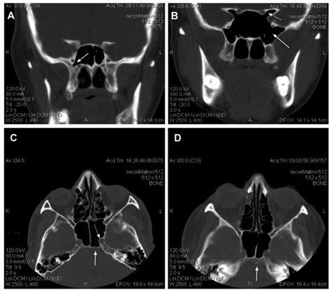 Scielo Brasil An Analysis Of Anatomic Variations Of The Sphenoid