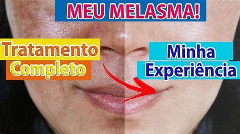 Melasma Como Tratar Clarear E Prevenir O Melasma Mancha Escura Na