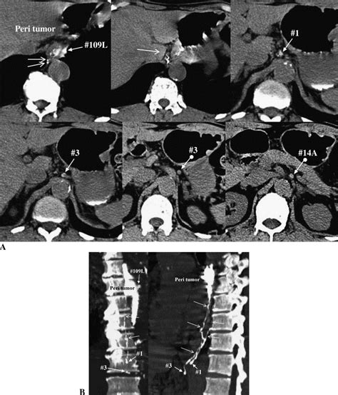 Ct Lymphography Navigated Sentinel Lymph Node Biopsy In Patients With