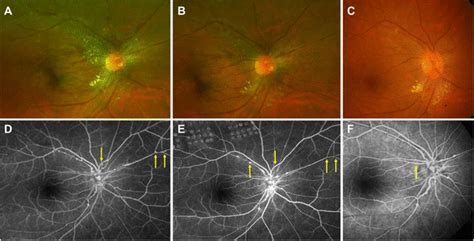 Comparison Of The Posterior Pole Fundus Photographs At Baseline A 6 Download Scientific