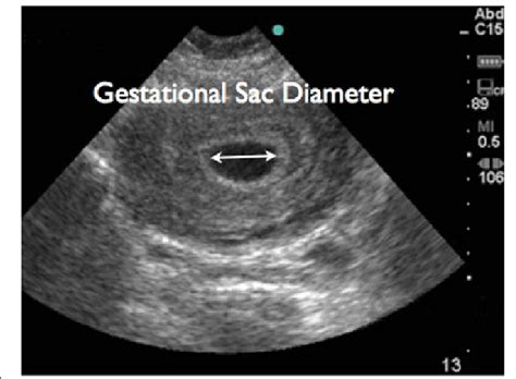 Gestational Sac Diameter Chart