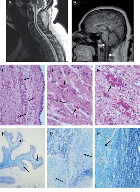 Figure 1 From Type II Adult Onset Alexander Disease In A Paraplegic