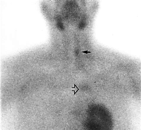 Parathyroid Imaging With Tc 99m Sestamibi Planar And Spect Scintigraphy