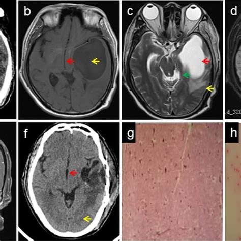 Neuroimaging And Pathological Findings In The First Hospitalization CT