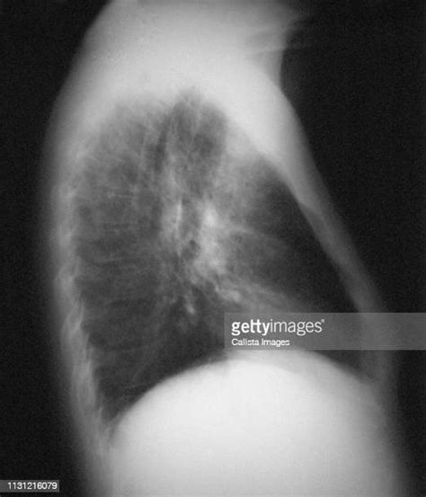 Pneumocystis Carini Photos And Premium High Res Pictures Getty Images