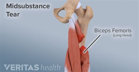 Hamstring Tears: Signs and Symptoms | Hamstrings, Torn hamstring, Leg injury