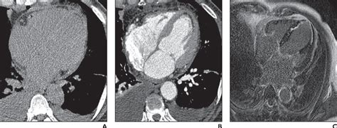 Figure 2—57 From Ct Detection Of Subendocardial Fat In Myocardial Infarction Semantic Scholar