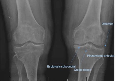 Gonartrosis De Rodillla Pr Tesis De Rodilla Dr Pablo Sanz