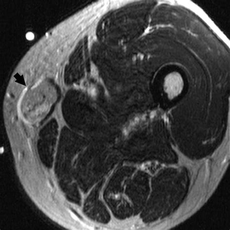 Superficial Soft Tissue Masses Analysis Diagnosis And Differential