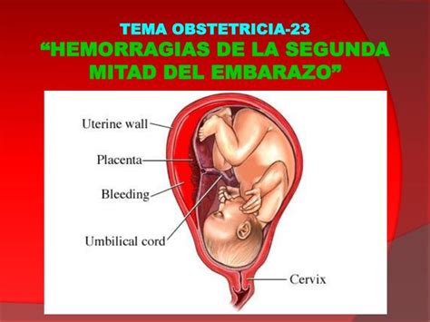 PPT TEMA OBSTETRICIA 23 HEMORRAGIAS DE LA SEGUNDA MITAD DEL EMBARAZO